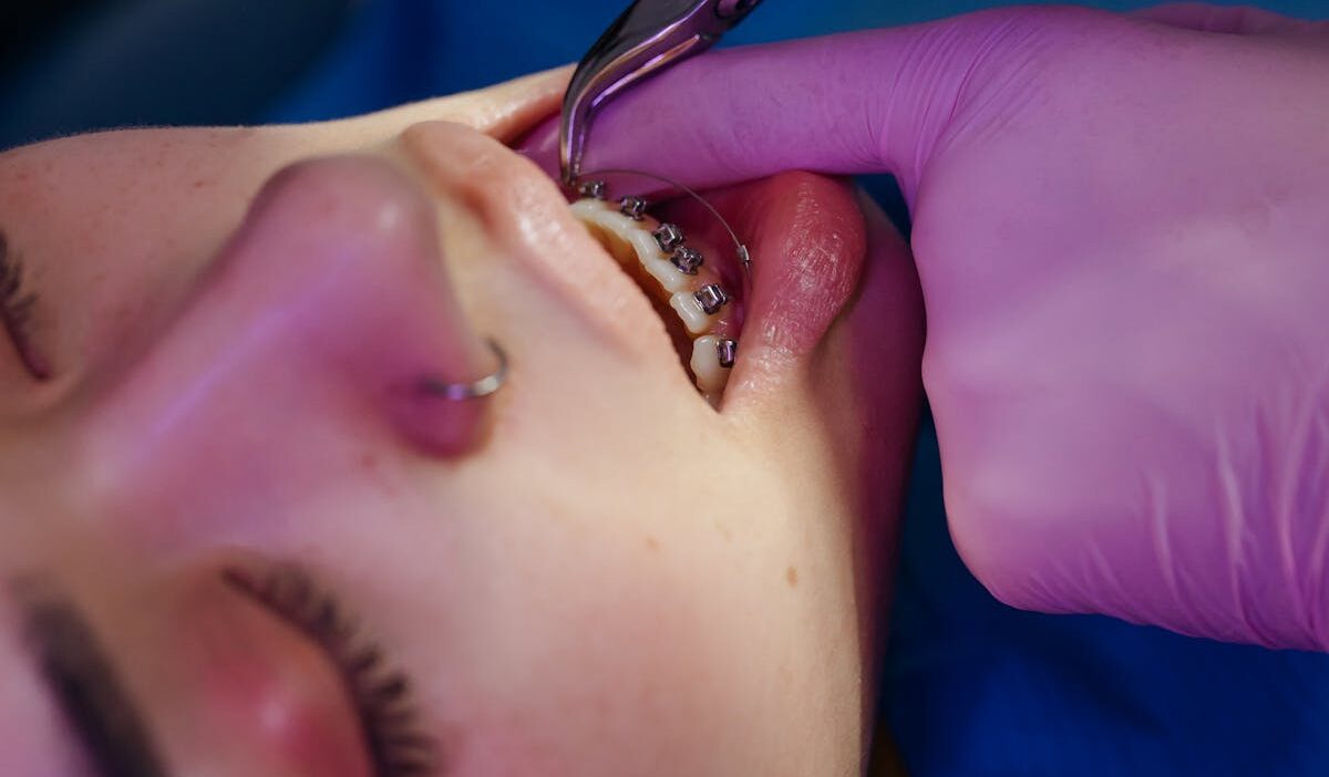 does-medicaid-cover-braces