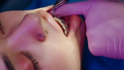 does-medicaid-cover-braces