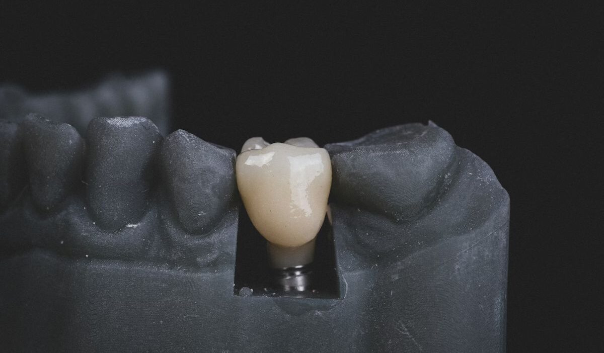 Does Medicaid Cover Dental Implants? Rules & Application Steps