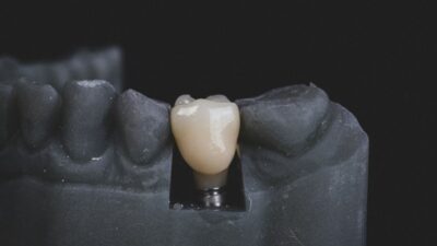 Does Medicaid Cover Dental Implants? Rules & Application Steps
