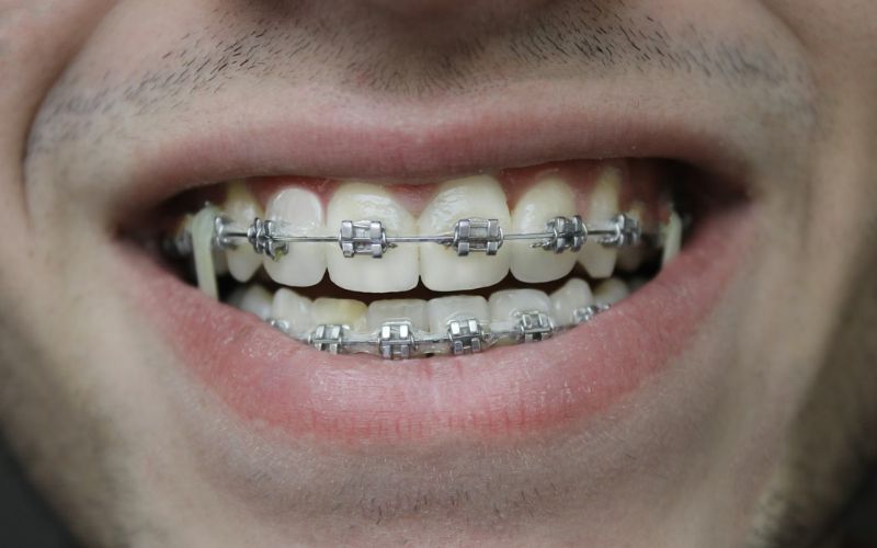 Medicaid cover braces depends on age, state rules, and orthodontic treatment (Image by Unsplash)