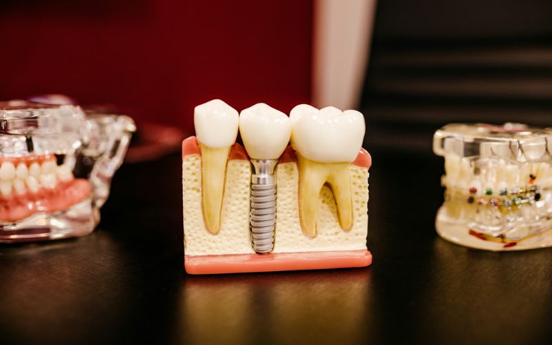 Medicaid cover dental implants does not have one universal answer (Image by Unsplash)