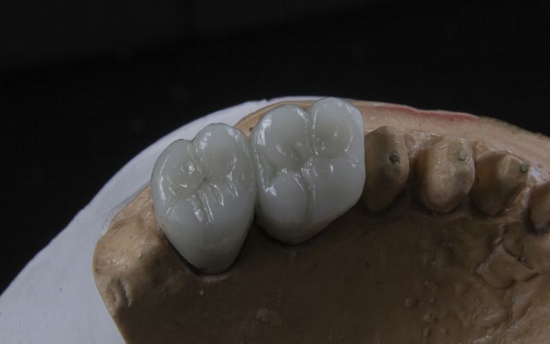 Ways to get Medicaid to cover dental implants (Image by Unsplash)
